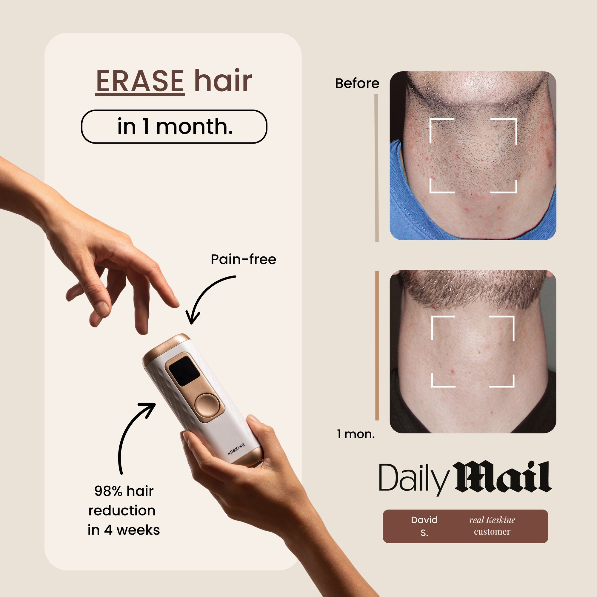 Keskine IPL Hair Removal Handset